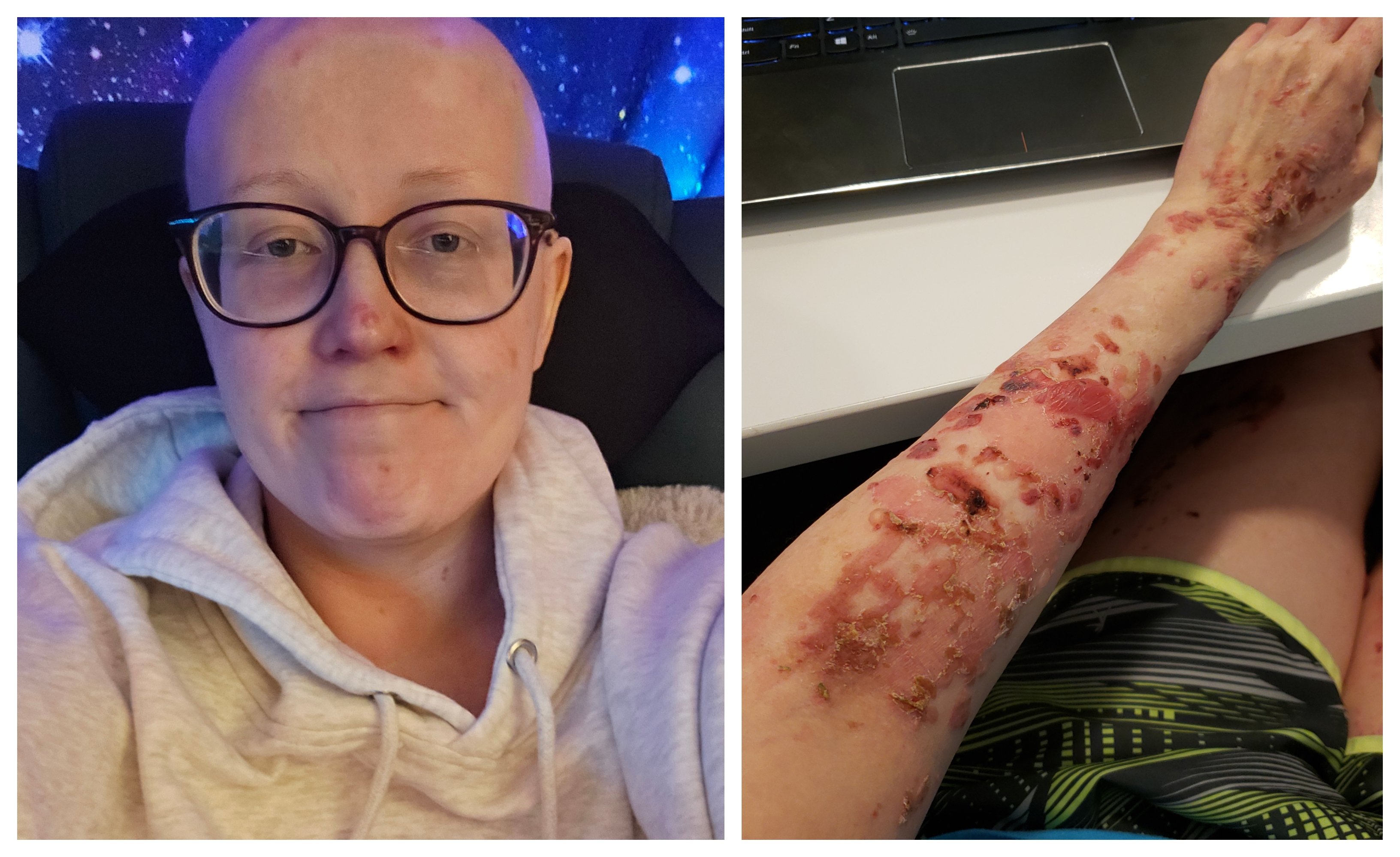 Epidedermolysis Bullosa Personal Story