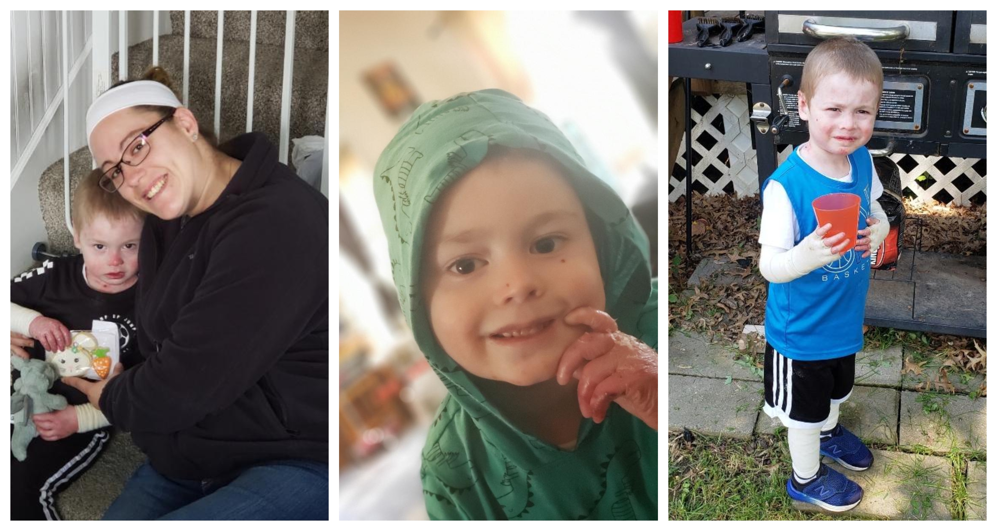 Epidermolysis Bullosa Personal Story