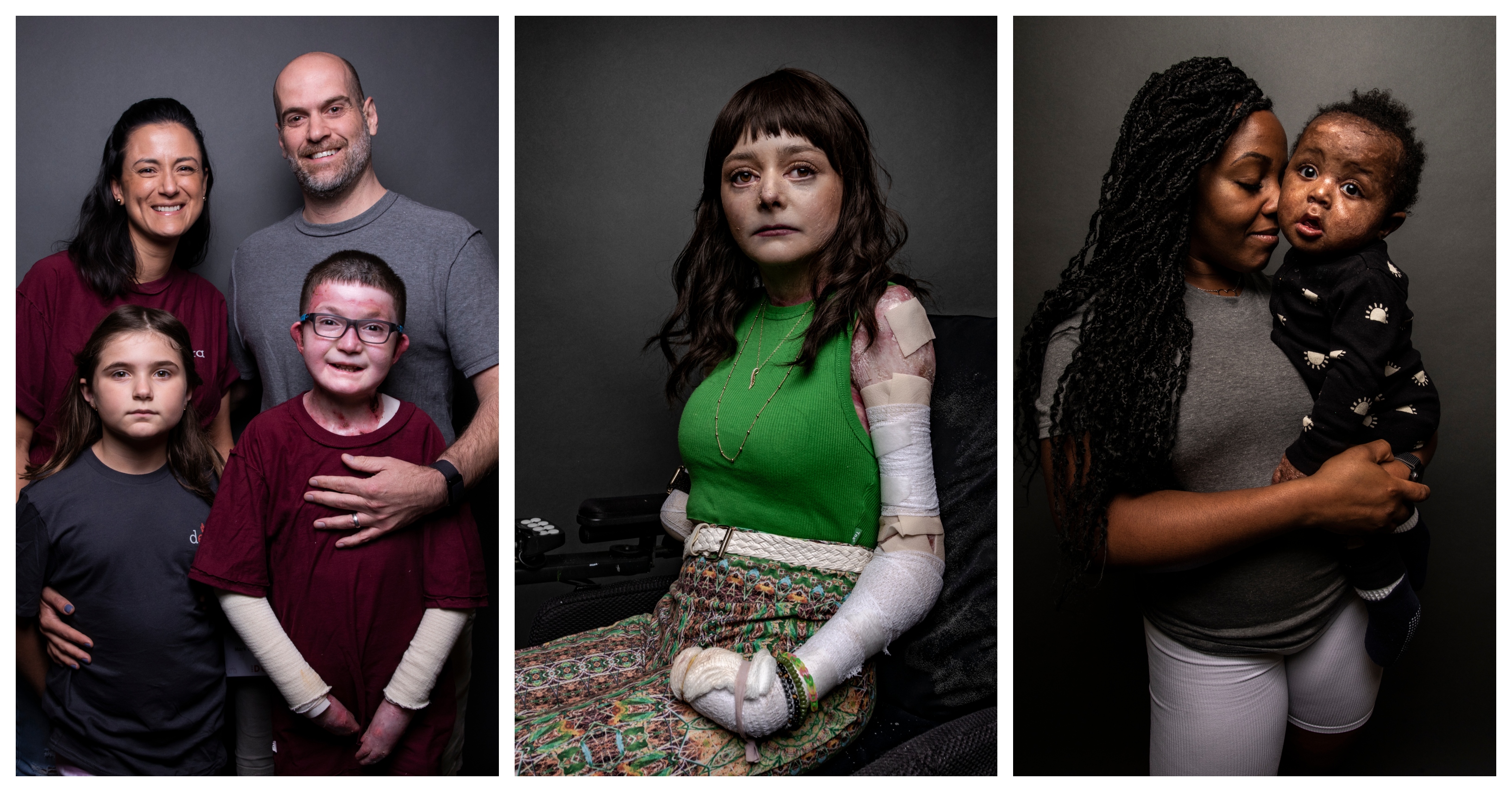 About Epidermolysis Bullosa (EB)