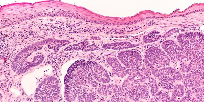 Cancer and Epidermolysis Bullosa