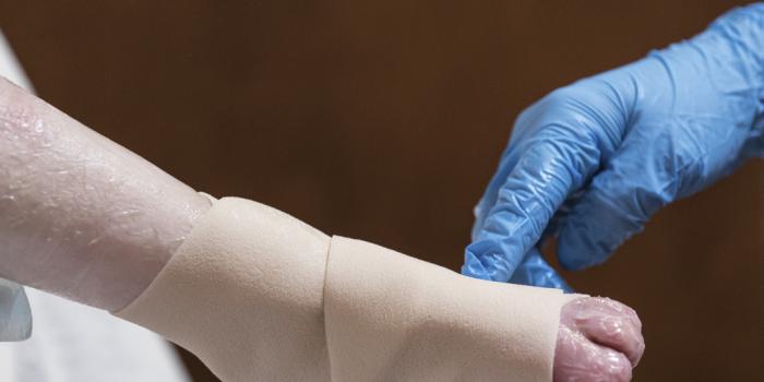 Hand and Foot Care Epidermolysis Bullosa