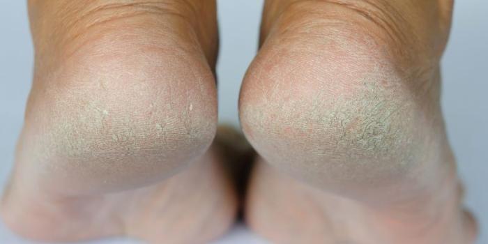 EB Callus Care