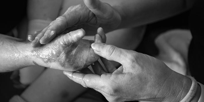 Dystrophic Nail Care