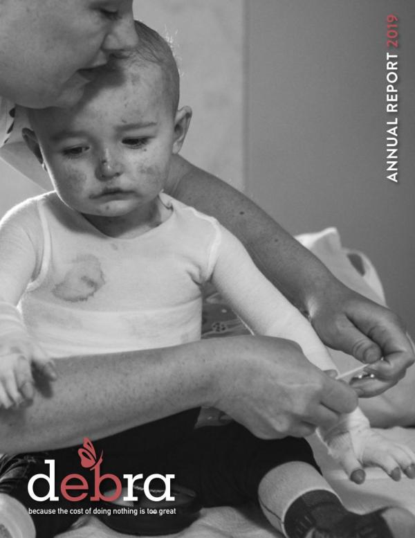 Epidermolysis Bullosa Support