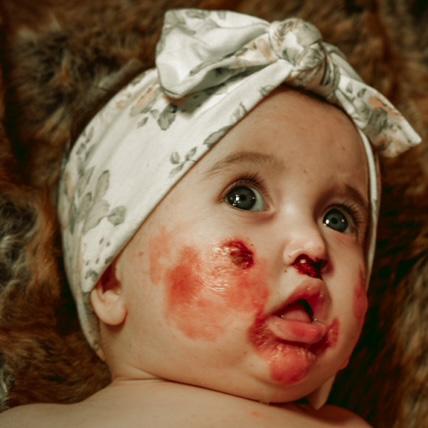 Epidermolysis Bullosa Personal Story